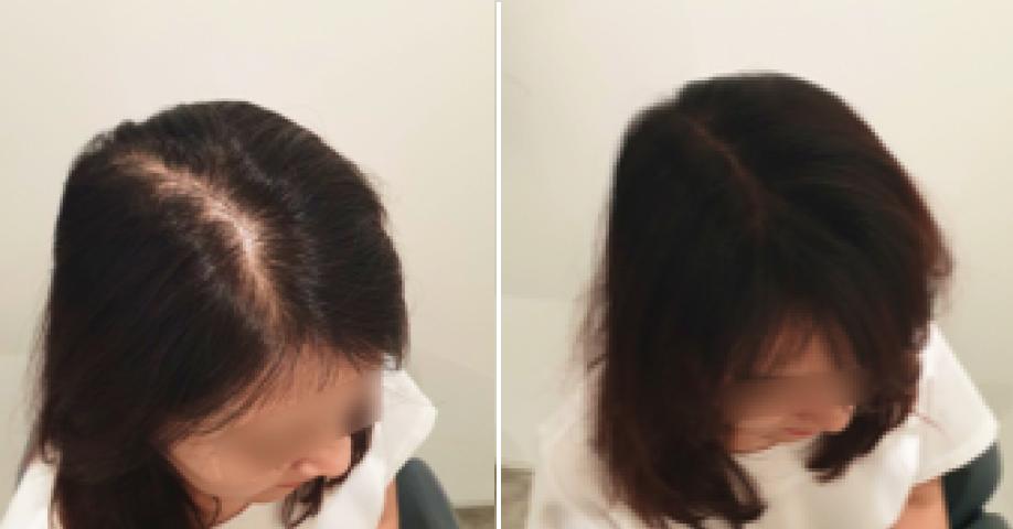 헤어라인 & 정수리 탈모 보완