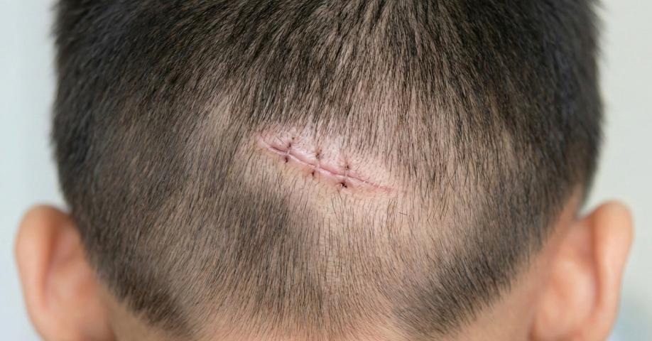 흉터 커버용 시술