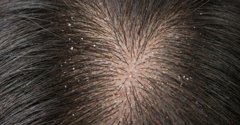 잦은 두피 염증 & 각질