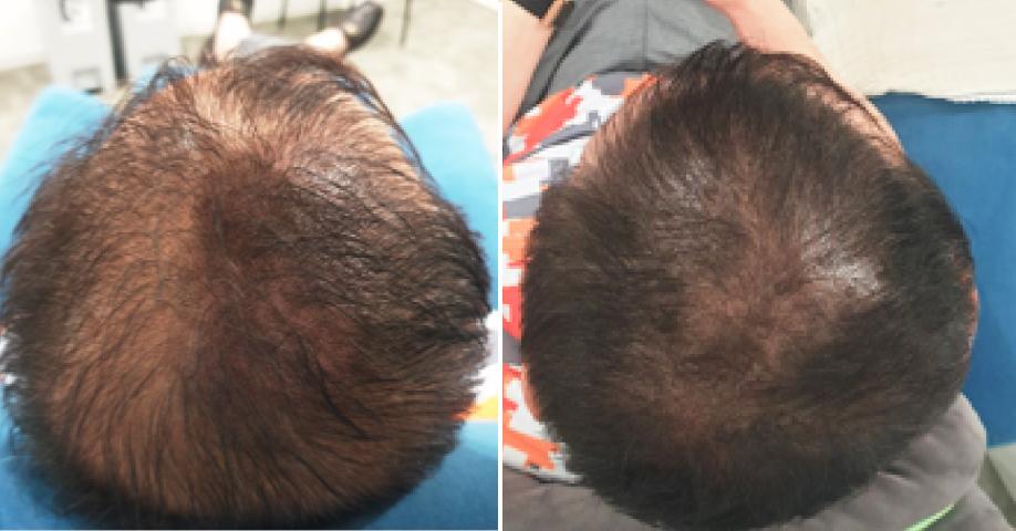 탈모 초기 & 가는 모발